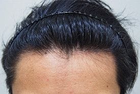 症例写真術後3