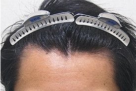症例写真術前3