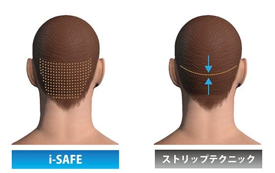 傷跡が目立たちにくい