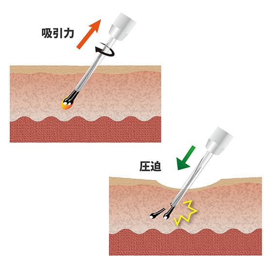 ダメージレスグラフト(移植毛)の採取