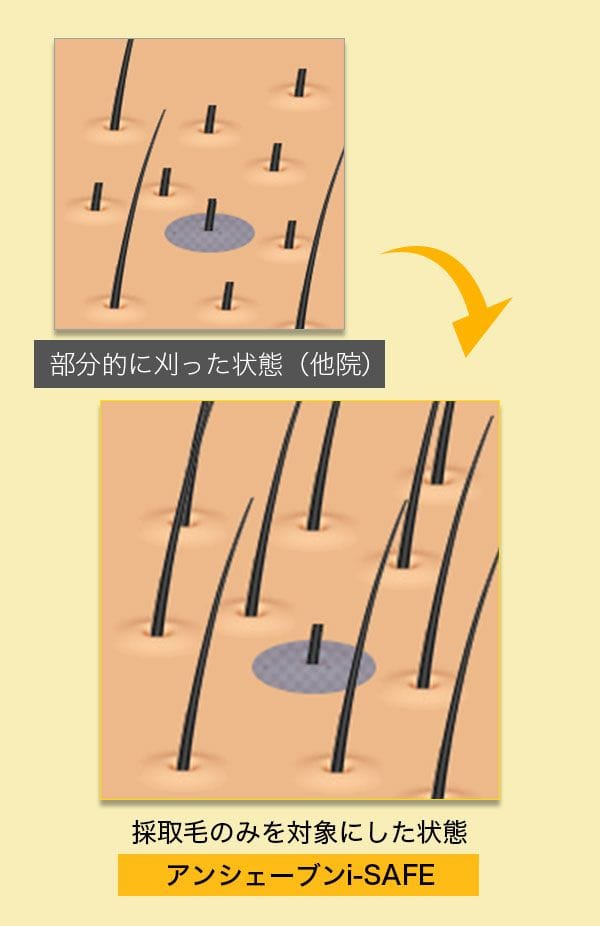 刈り上げないアンシェーブンi-SAFE