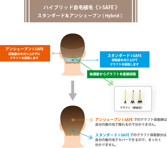 ハイブリッド自毛植毛i-SAFEスタンダード＆アンシェープンイメージ