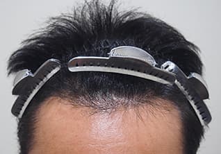 治療後の写真