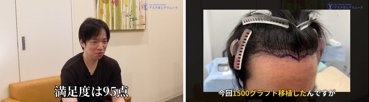 2回目植毛の仕上がり満足度