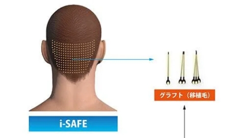 メスを使わない負担の少ない採取法「i-SAFE法」