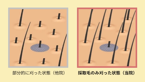 後頭部を刈り上げない アンシェーヴンi-SAFE