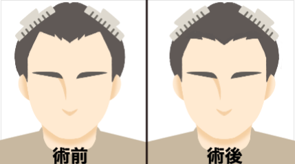 浅めのM字修正