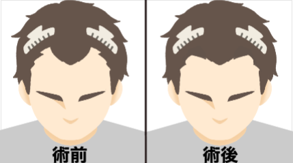 やや深いM字・前頭部修正