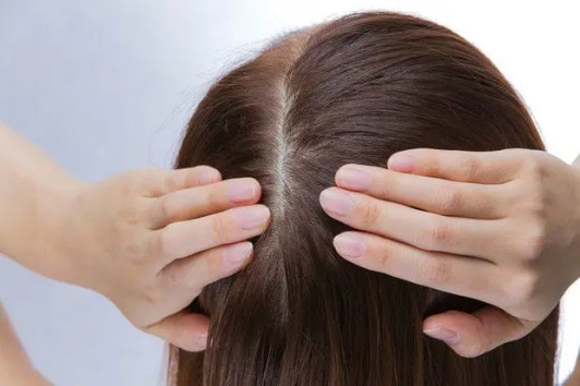 女性のための薄毛治療