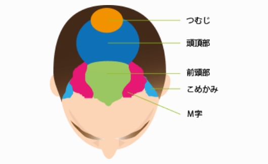 将来を見据えた、限られた資源である自毛の効率的分配のご提案