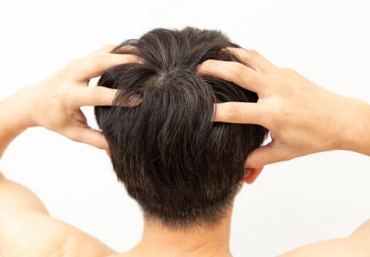 切らない植毛手術なので目立ちにくい