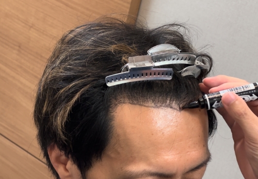 自然な仕上がりを重視する生え際の植毛デザイン
