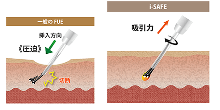 吸引補助で切断率が減少画像2