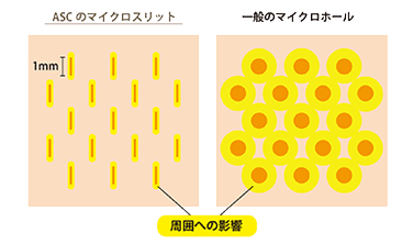 マイクロスリット、ニードルによる微細な移植孔画像2