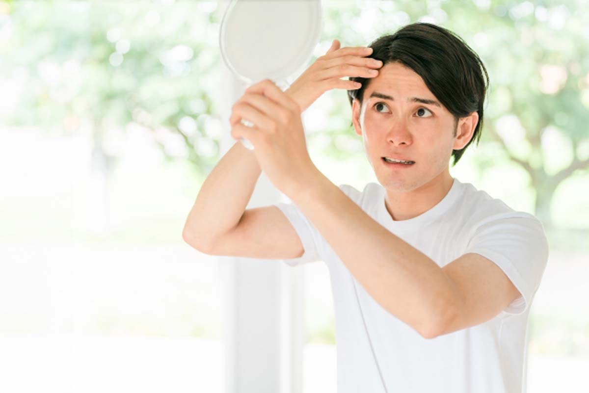 若年性脱毛症