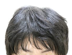 症例写真術後43_1