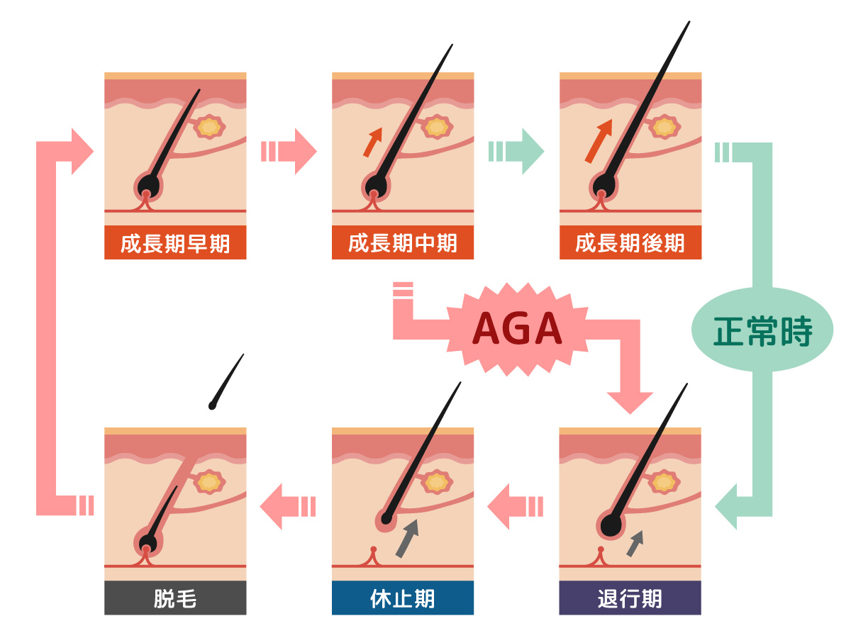 AGA原因
