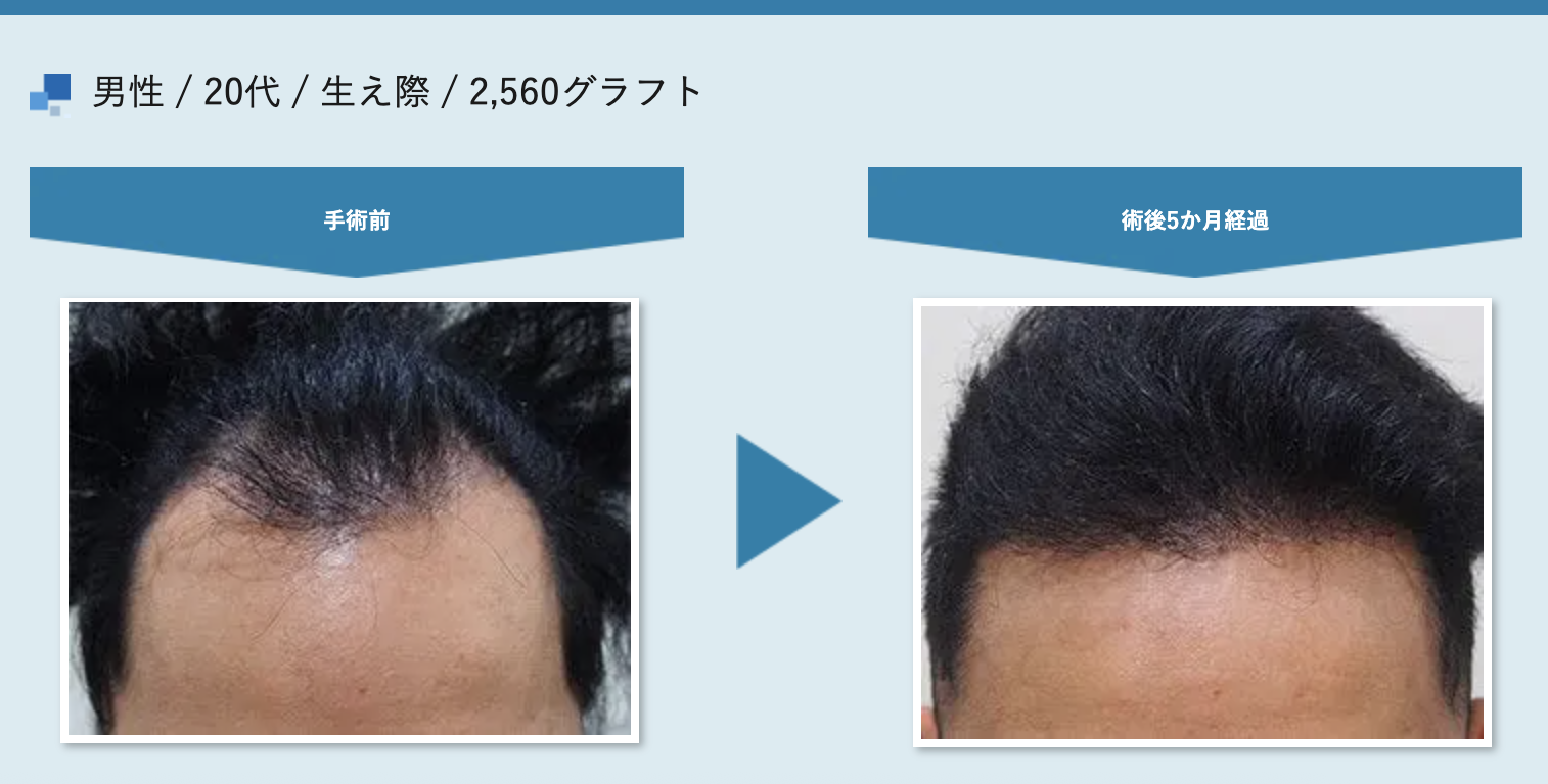 生え際の後退に悩んでいた20代男性の植毛症例