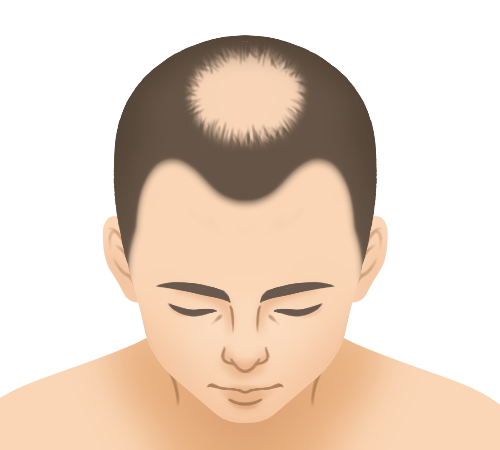 頭頂部の薄毛スライド画像1