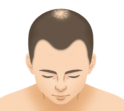 つむじの薄毛スライド画像1