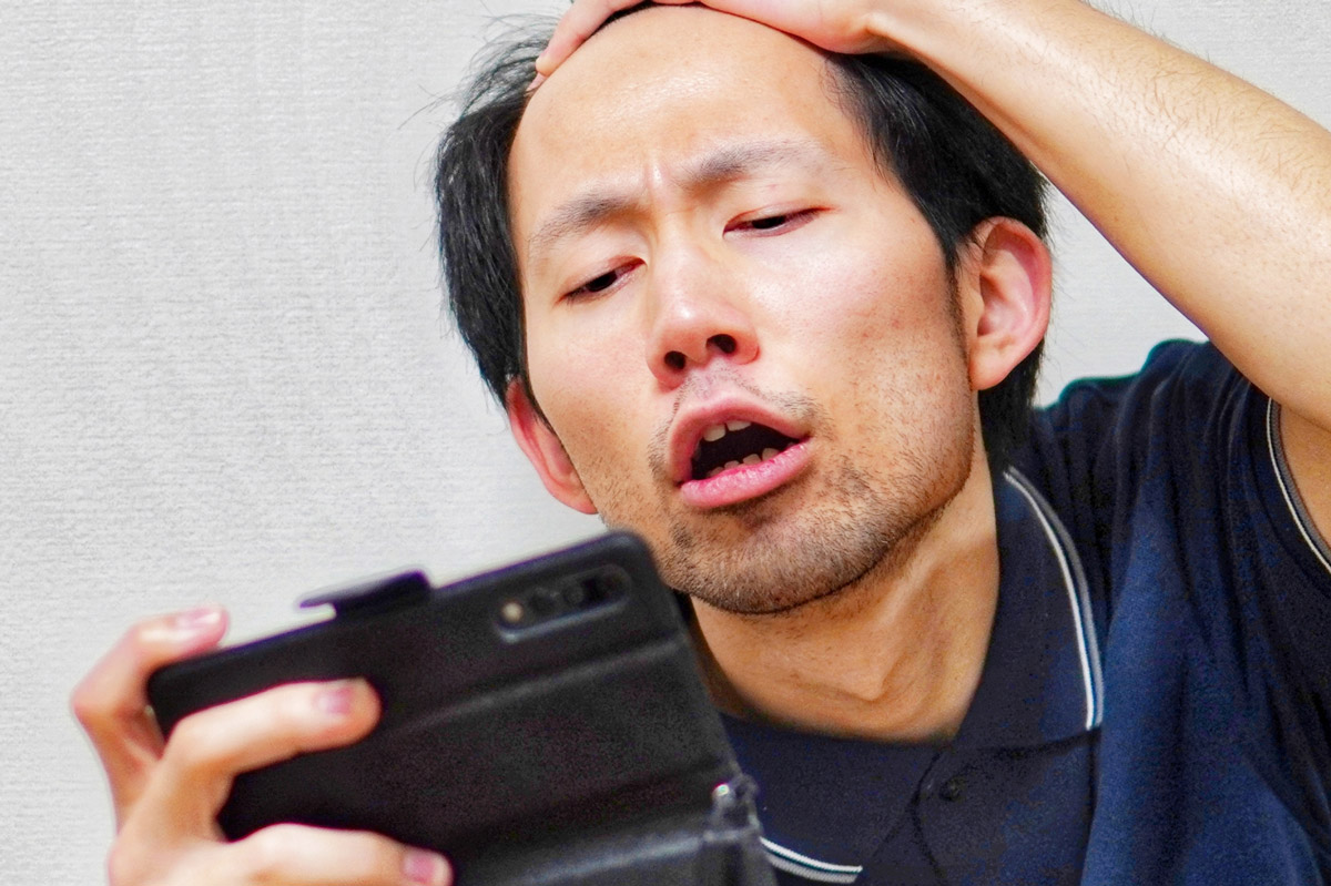 生え際後退の対策とは？原因から医学的に効果的な治療まで解説