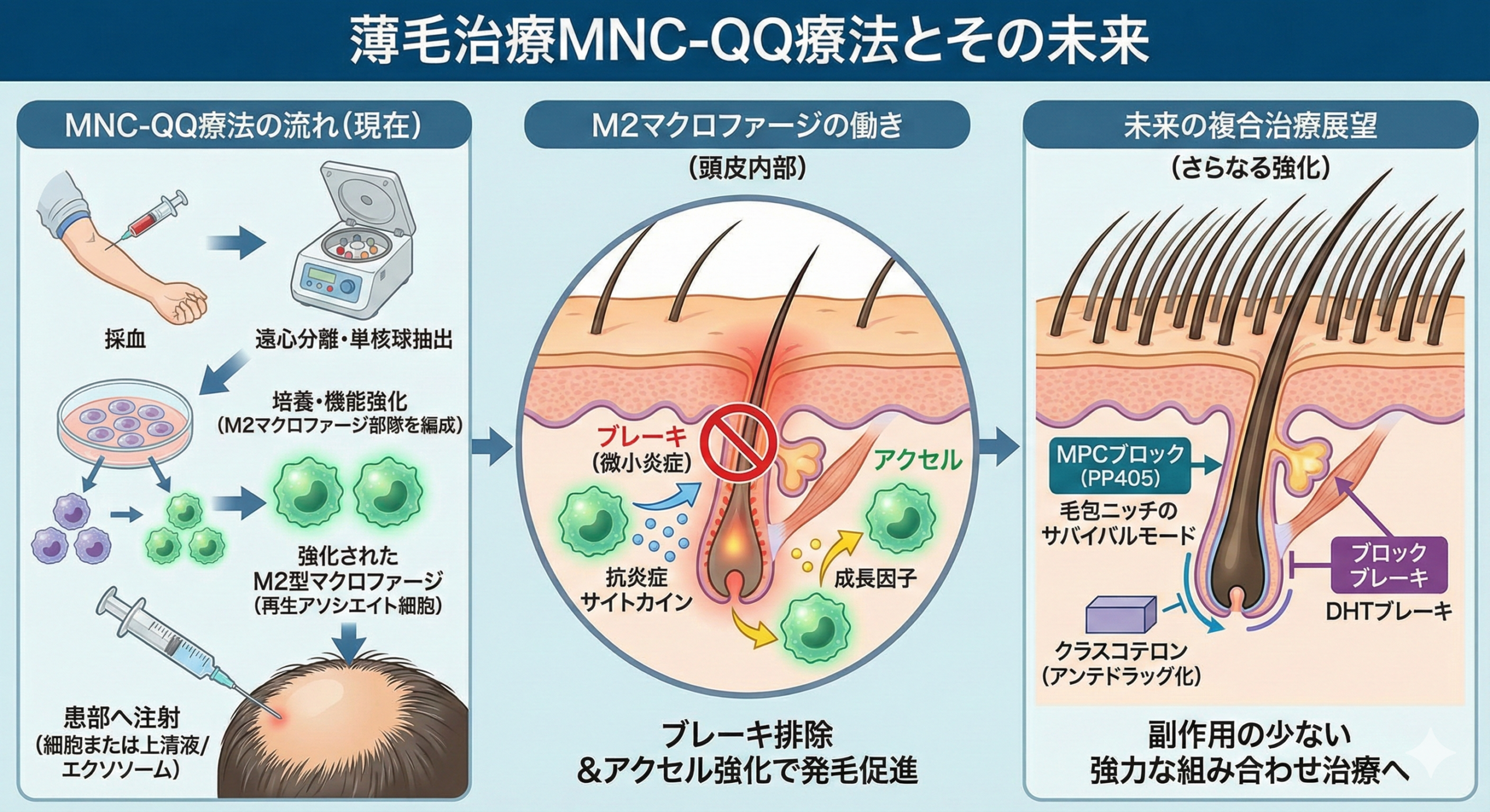 薄毛治療MNC-QQ療法とその未来
