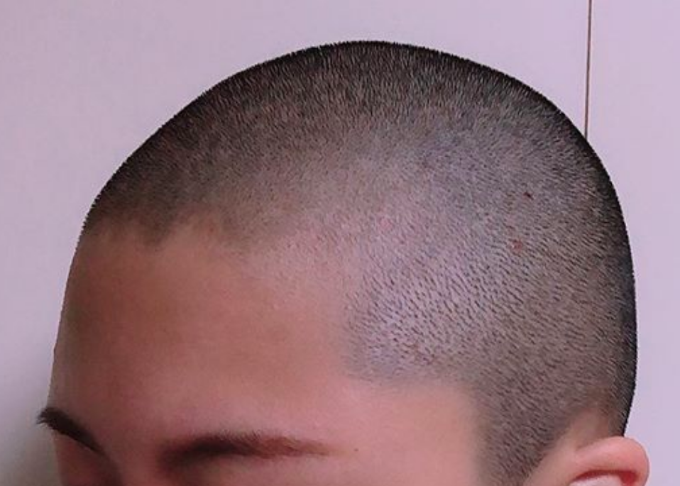 典型的な生え際