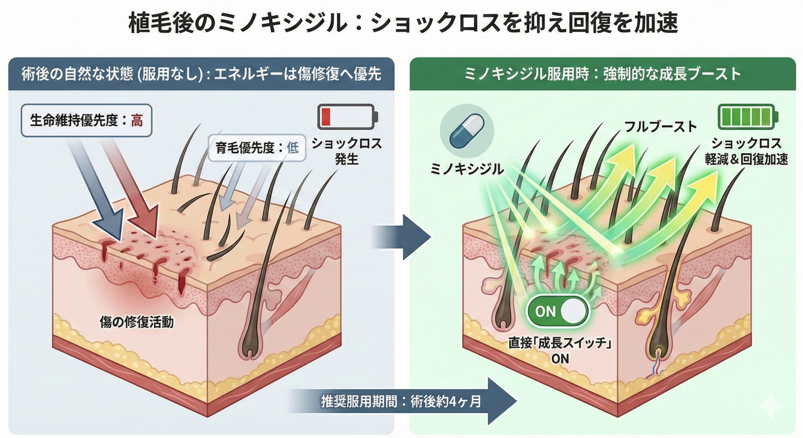 植毛後のミノキシジル